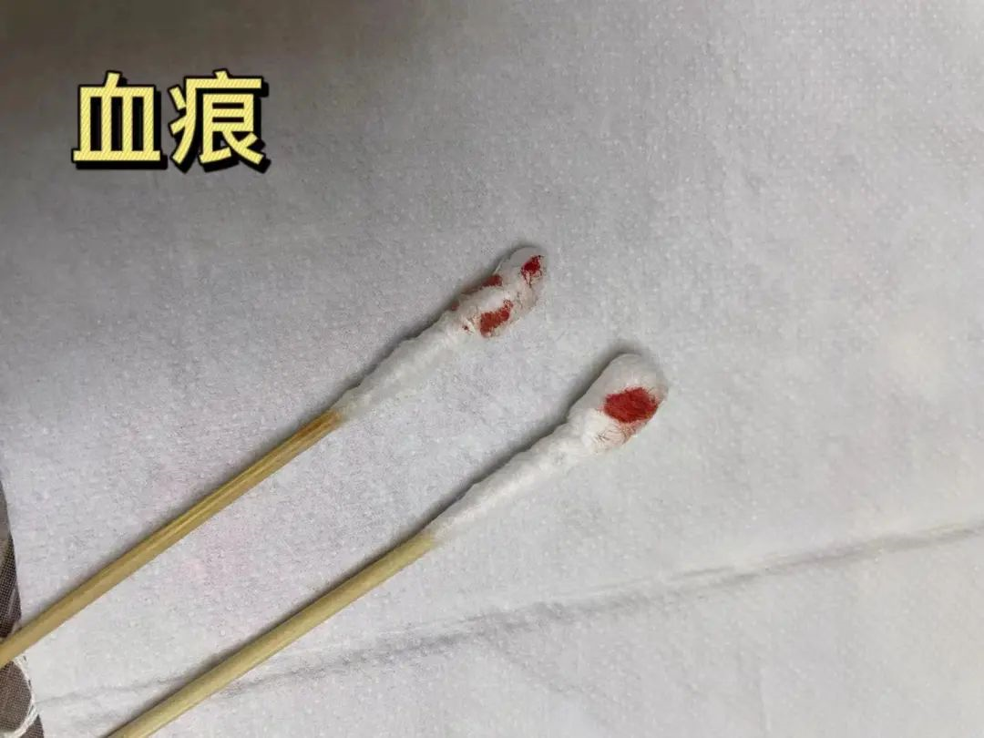 親子鑒定樣本采集棉棒上的血痕可以嗎？